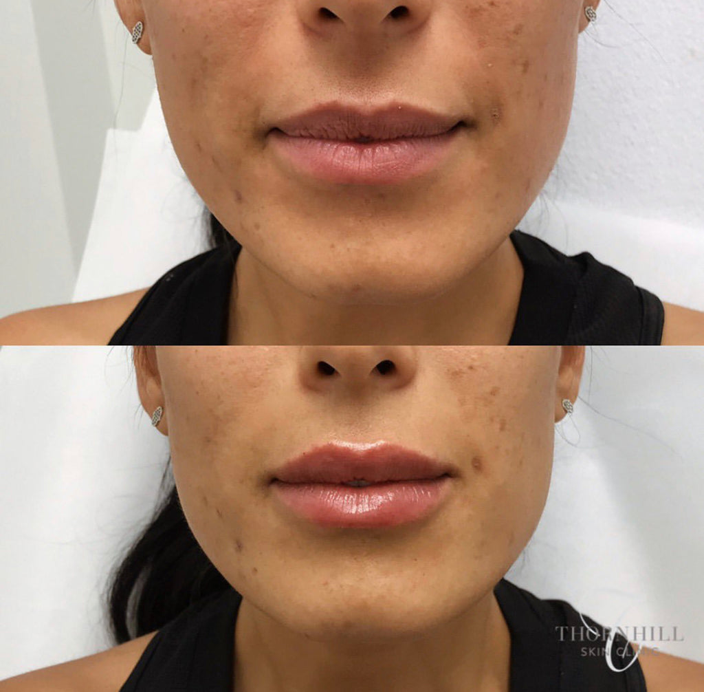 EXCLUSIVE EVENT PRICING : DERMAL FILLER - THORNHILL SKIN CLINIC