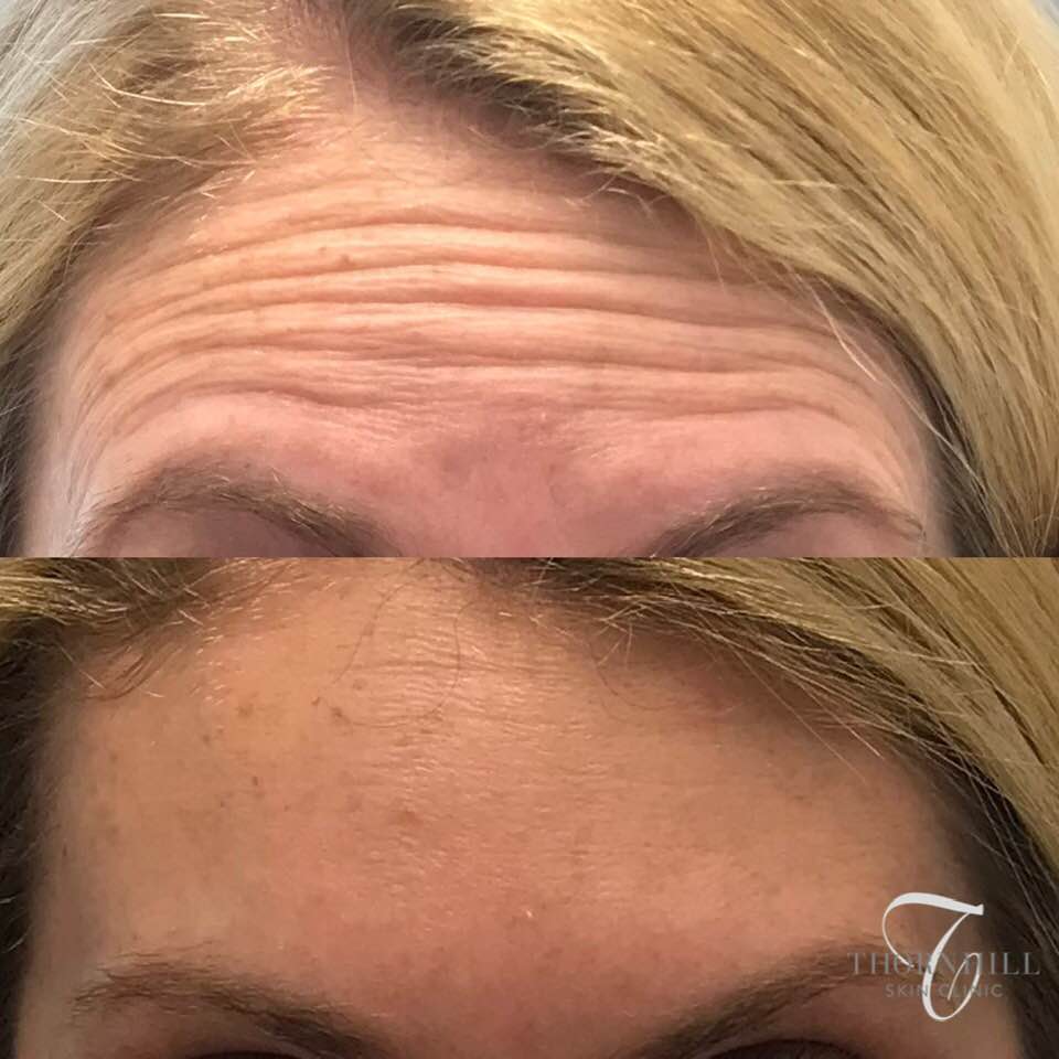 EXCLUSIVE EVENT PRICING : BOTOX INJECTIONS - THORNHILL SKIN CLINIC