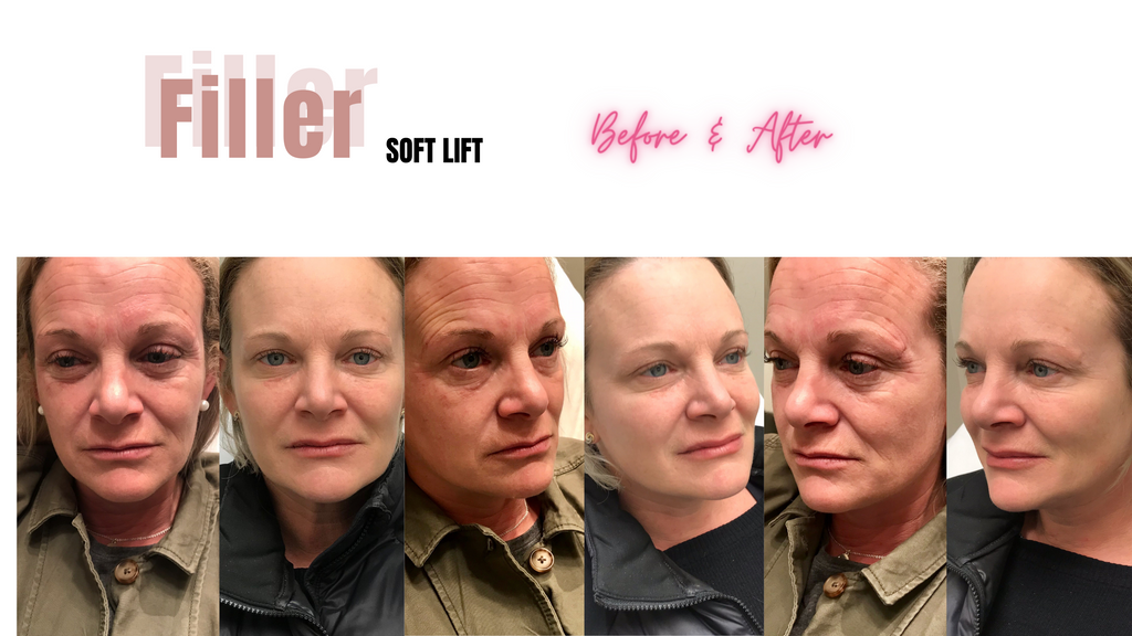 EXCLUSIVE EVENT PRICING : DERMAL FILLER - THORNHILL SKIN CLINIC