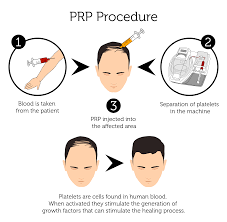 EXCLUSIVE EVENT PRICING: PRP - THORNHILL SKIN CLINIC