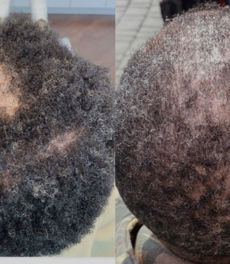 EXCLUSIVE EVENT PRICING: PRP + PRF - THORNHILL SKIN CLINIC